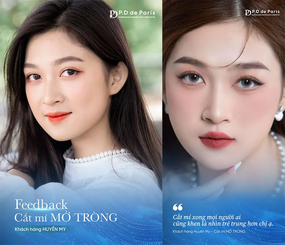 Vì sao hốc mắt sâu? Nguyên nhân và cách khắc phục hiệu quả nhất