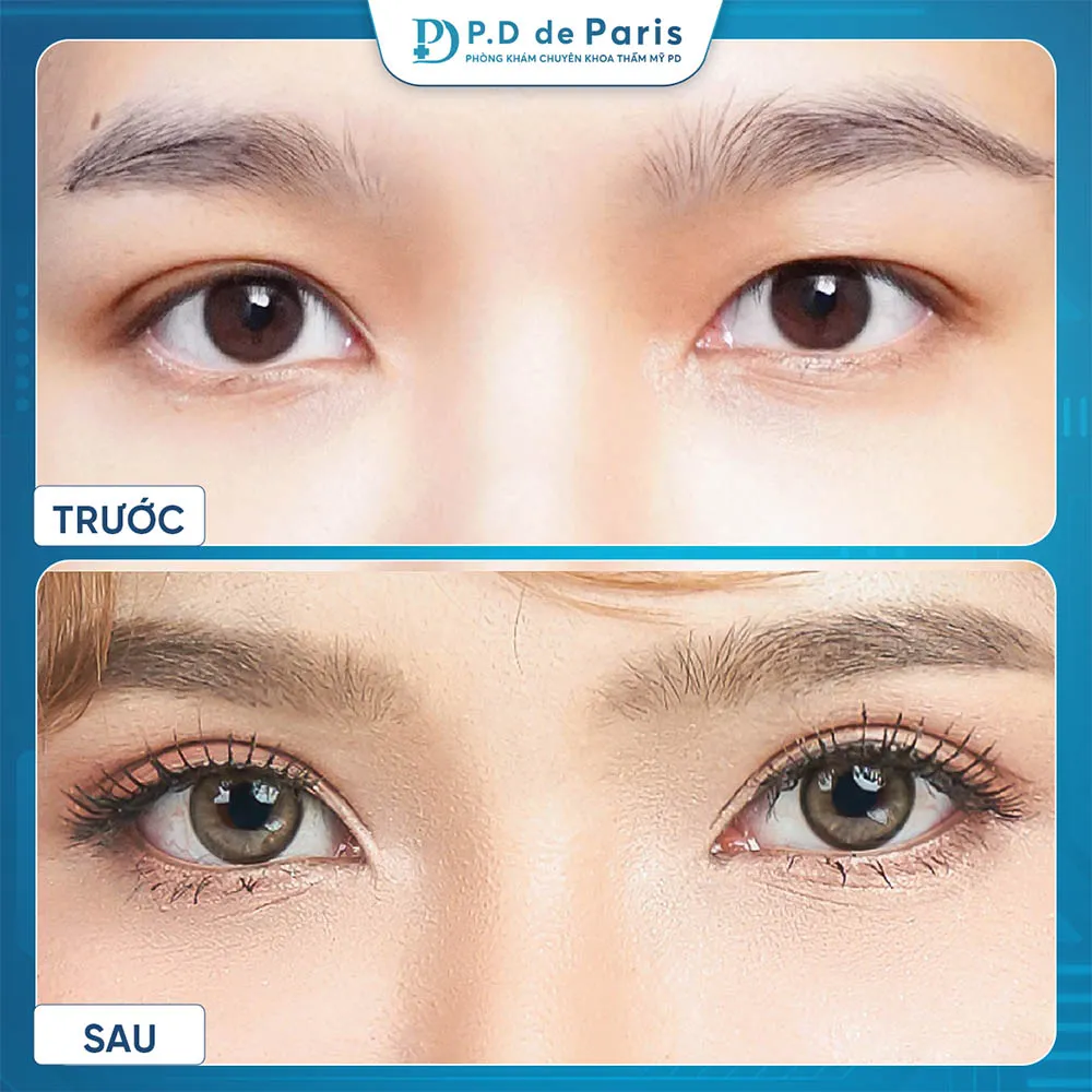 Vì sao hốc mắt sâu? Nguyên nhân và cách khắc phục hiệu quả nhất