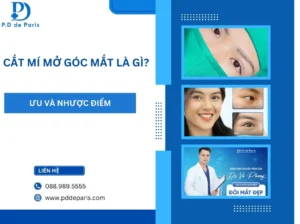Cắt mí mở góc mắt là gì? Ưu nhược điểm của phương pháp thẩm mỹ này