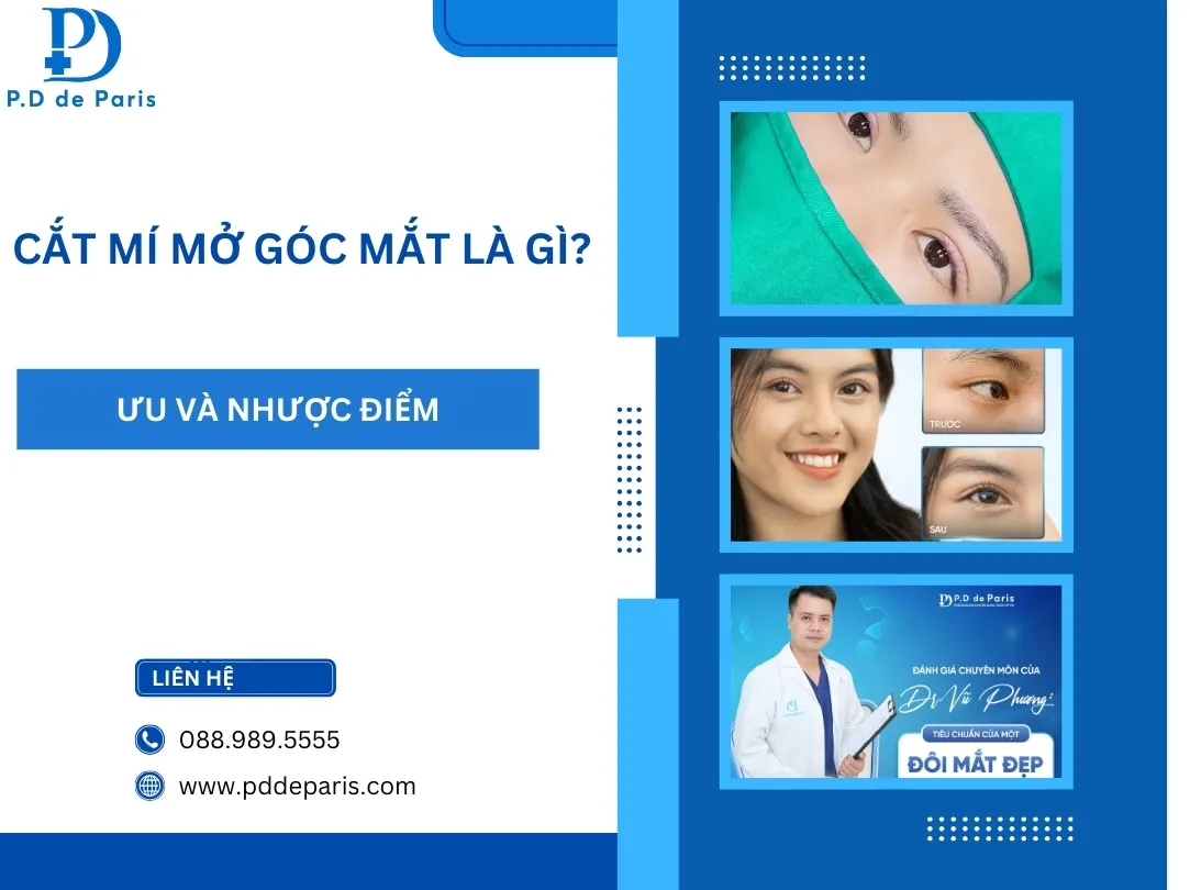 Cắt mí mở góc mắt là gì? Ưu nhược điểm của phương pháp thẩm mỹ này