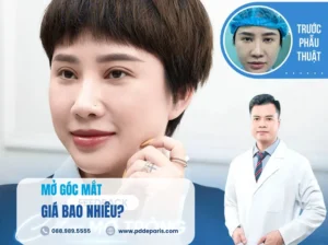 Mở góc mắt giá bao nhiêu? Cập nhập bảng giá mở góc mắt trong và ngoài