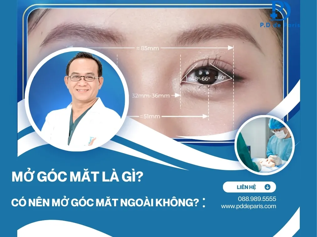 Mở góc mắt là gì? Có nên mở góc mắt trong ngoài không?