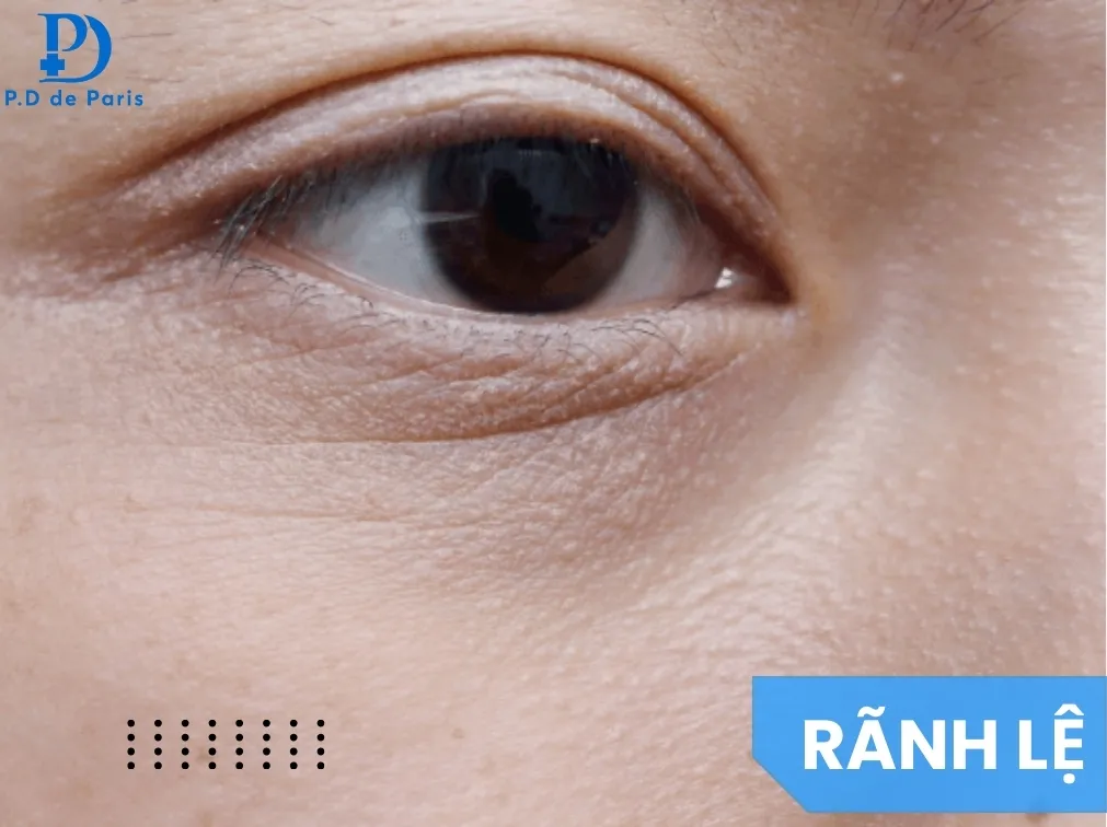 Nguyên nhân gây rãnh lệ (khuyết lõm cạnh bọng mắt) và phương pháp khắc phục