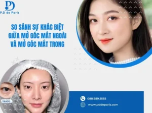 So sánh sự khác biệt giữa mở góc mắt ngoài và mở góc mắt trong