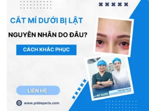 Cắt mí dưới bị lật: Nguyên nhân và cách khắc phục hiệu quả nhất