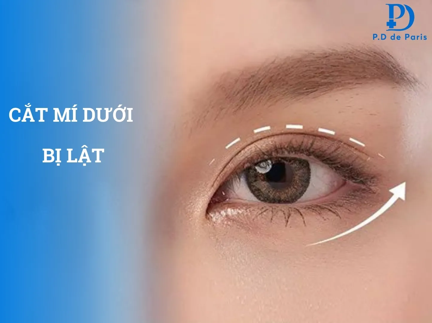 Cắt mí dưới bị lật: Nguyên nhân và cách khắc phục hiệu quả nhất
