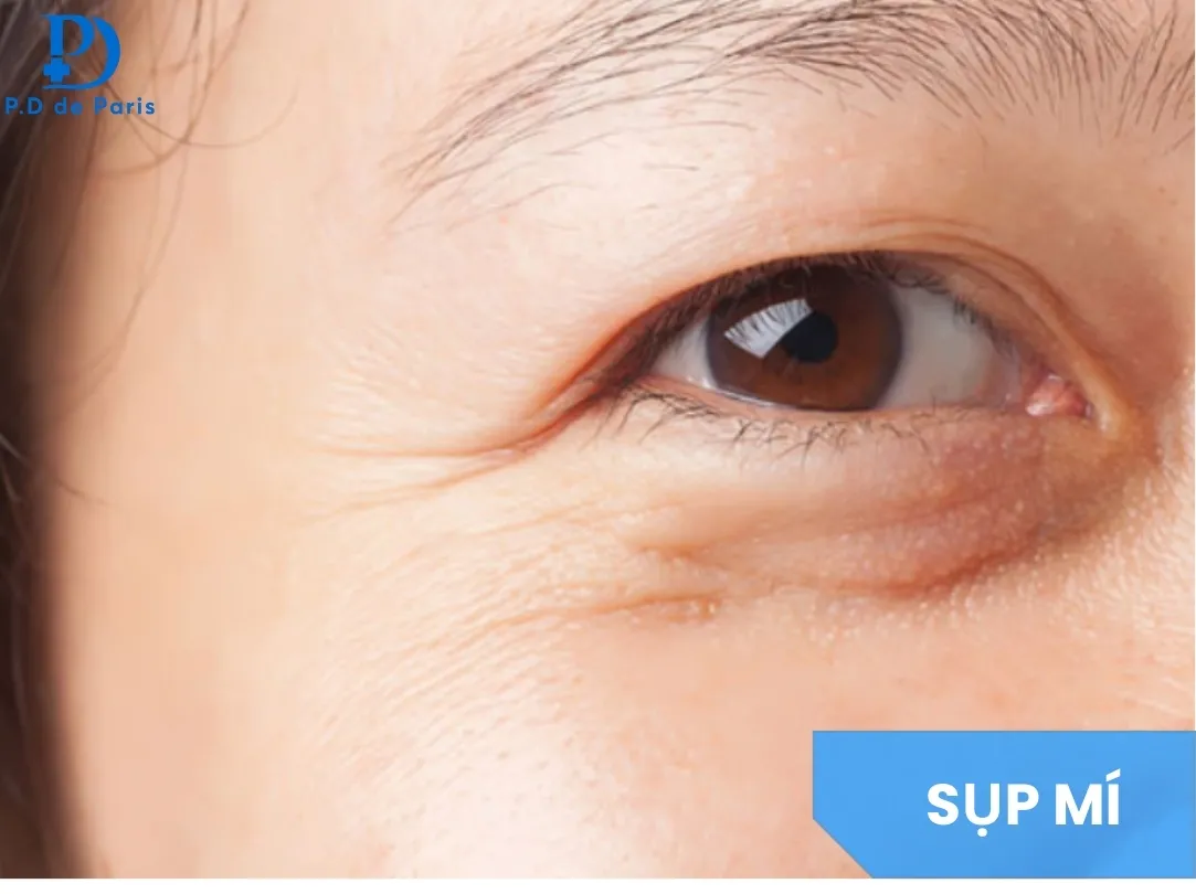 Cắt Mí Mắt Bị Sụp Có Sao Không? Nguyên Nhân, Mức Độ & Cách Khắc Phục