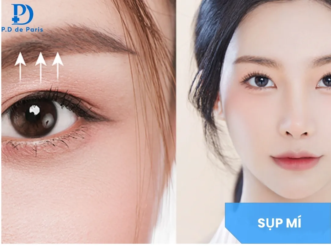 Cắt Mí Mắt Bị Sụp Có Sao Không? Nguyên Nhân, Mức Độ & Cách Khắc Phục