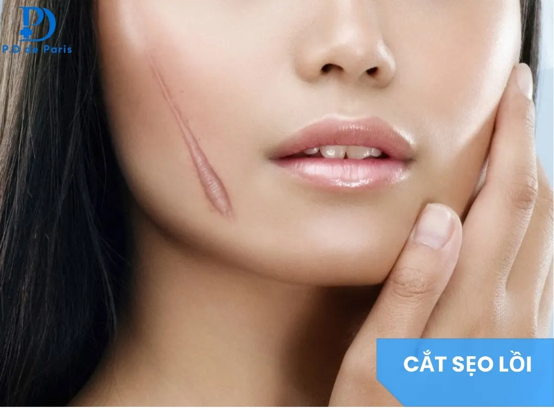 Cắt Sẹo Lồi Có Hiệu Quả Không? Khi Nào Nên Cắt & Ưu Nhược Điểm Cần Biết