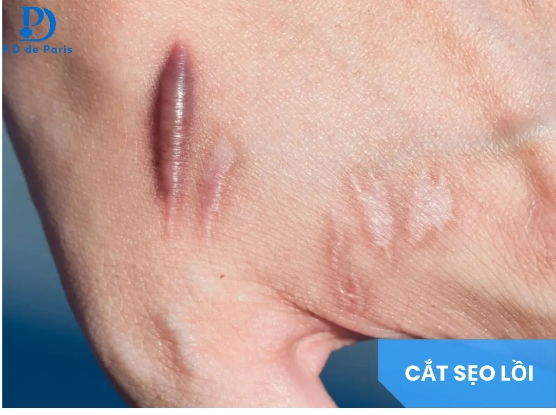 Cắt Sẹo Lồi Có Hiệu Quả Không? Khi Nào Nên Cắt & Ưu Nhược Điểm Cần Biết