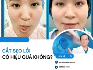 Cắt Sẹo Lồi Có Hiệu Quả Không? Khi Nào Nên Cắt & Ưu Nhược Điểm Cần Biết