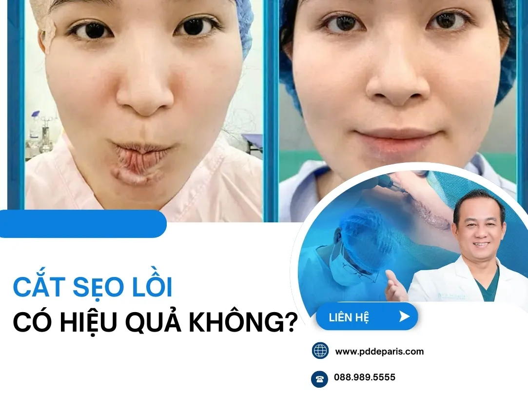Cắt Sẹo Lồi Có Hiệu Quả Không? Khi Nào Nên Cắt & Ưu Nhược Điểm Cần Biết
