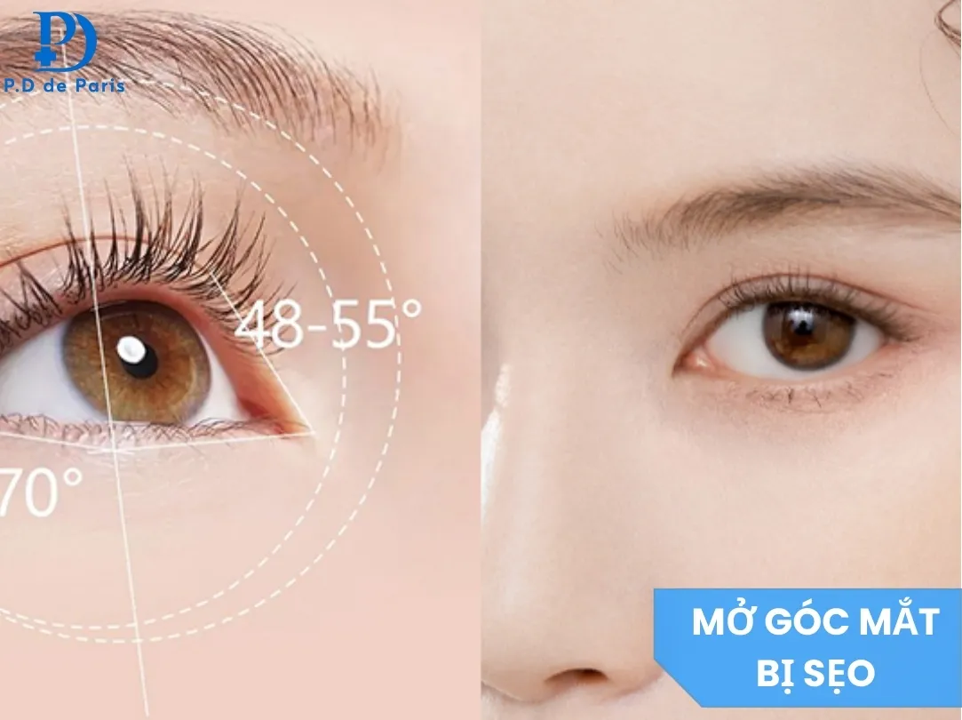 Mở Góc Mắt Trong Bị Sẹo: Nguyên Nhân, Dấu Hiệu & Cách Xử Lý Hiệu Quả