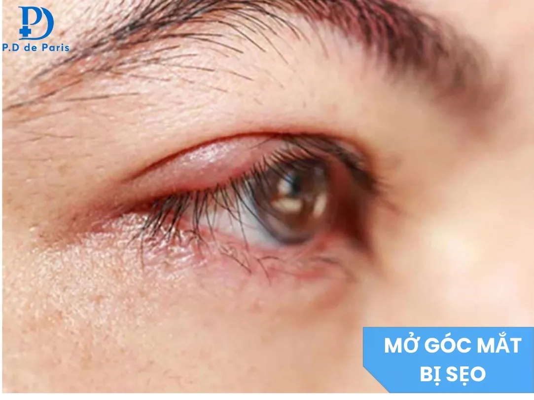 Mở Góc Mắt Trong Bị Sẹo: Nguyên Nhân, Dấu Hiệu & Cách Xử Lý Hiệu Quả