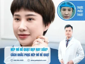 Nếp mí rẻ quạt đẹp hay xấu? Cách khắc phục nếp mí rẻ quạt hiệu quả