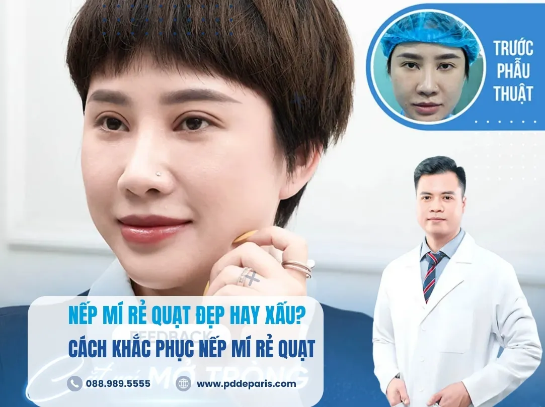Nếp mí rẻ quạt đẹp hay xấu? Cách khắc phục nếp mí rẻ quạt hiệu quả