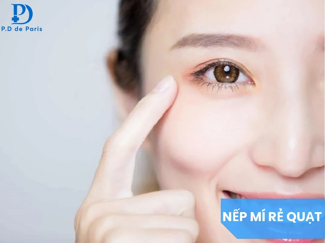 Nếp mí rẻ quạt đẹp hay xấu? Cách khắc phục nếp mí rẻ quạt hiệu quả