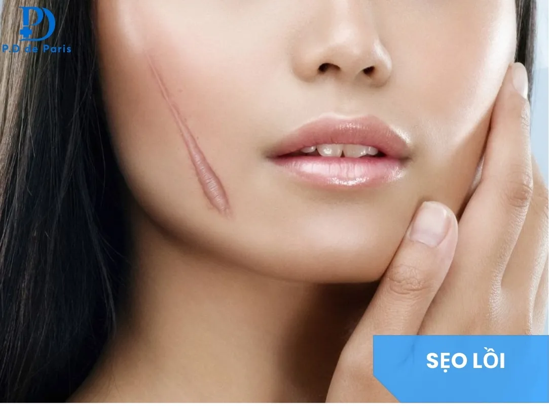 Sẹo Lồi Có Hết Không? Các Phương Pháp Điều Trị Hiệu Quả & Ít Tái Phát