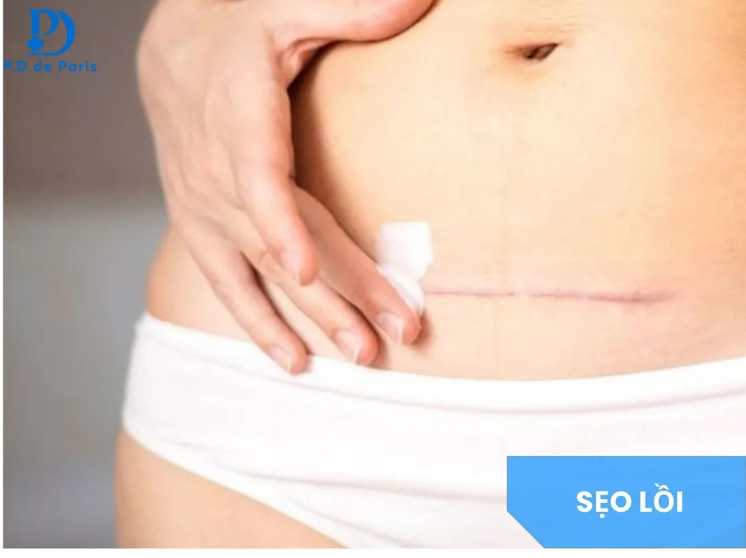 Sẹo Lồi Có Hết Không? Các Phương Pháp Điều Trị Hiệu Quả & Ít Tái Phát