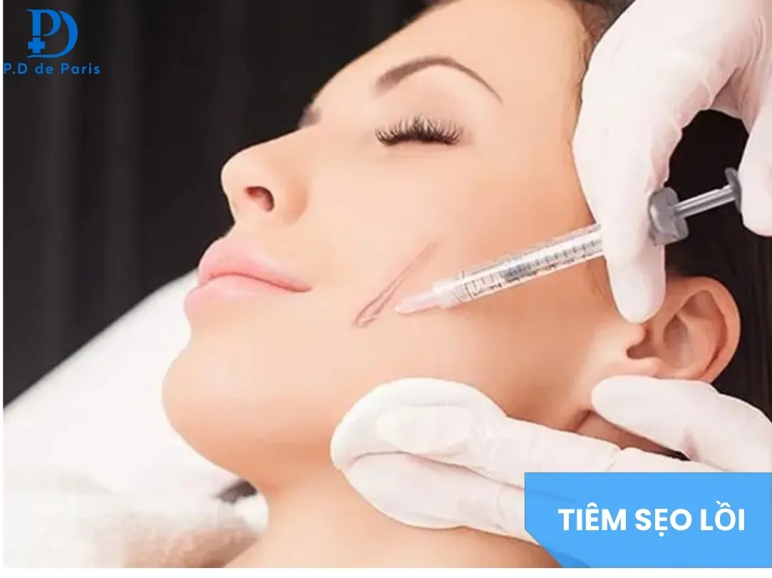 Sẹo Lồi Mụn Trứng Cá Có Hết Không? Các Phương Pháp Loại Bỏ An Toàn, Ít Tái Phát