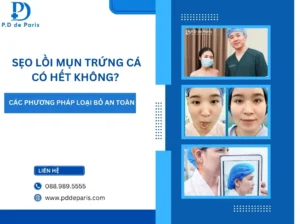 Sẹo Lồi Mụn Trứng Cá Có Hết Không? Các Phương Pháp Loại Bỏ An Toàn, Ít Tái Phát