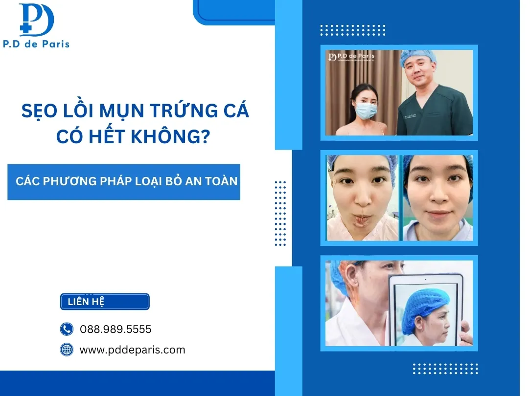 Sẹo Lồi Mụn Trứng Cá Có Hết Không? Các Phương Pháp Loại Bỏ An Toàn, Ít Tái Phát
