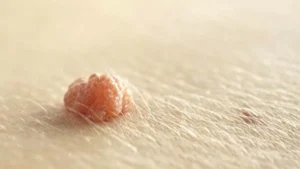 6 Cách điều trị mụn đá ở mũi tại nhà với các nguyên liệu thiên nhiên