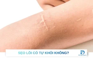 Bị sẹo lồi có tự khỏi không? Có tự hết được không?
