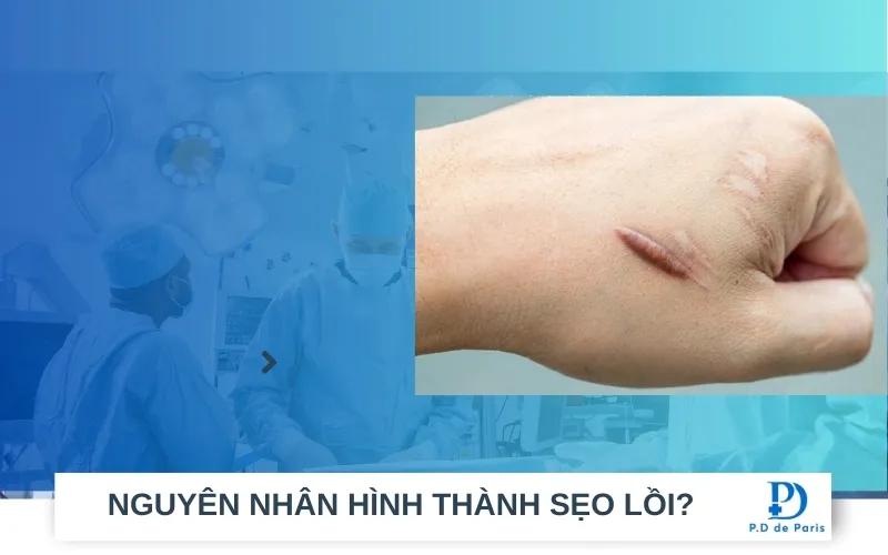 Bị sẹo lồi có tự khỏi không? Có tự hết được không?