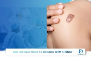 Cách khắc phục sẹo lồi ngày càng to an toàn hiệu quả nhất