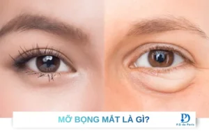 Cách lấy mỡ bọng mắt không cần phẫu thuật đơn giản dễ thực hiện tại nhà