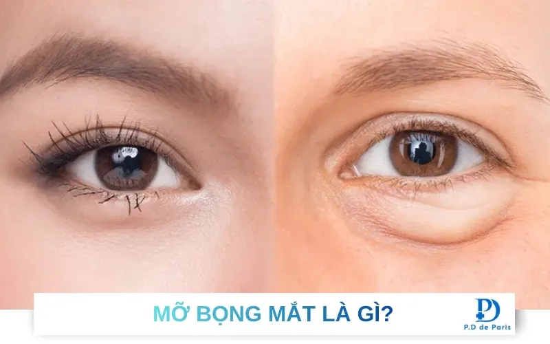 Cách lấy mỡ bọng mắt không cần phẫu thuật đơn giản dễ thực hiện tại nhà