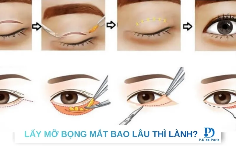 Lấy mỡ bọng mắt bao lâu thì lành? Khi Nào Đẹp Tự Nhiên?