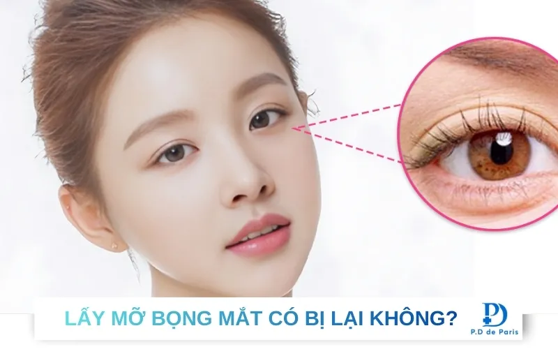 Lấy mỡ bọng mắt có bị lại không? Cách chăm sóc sau khi lấy bọng mắt