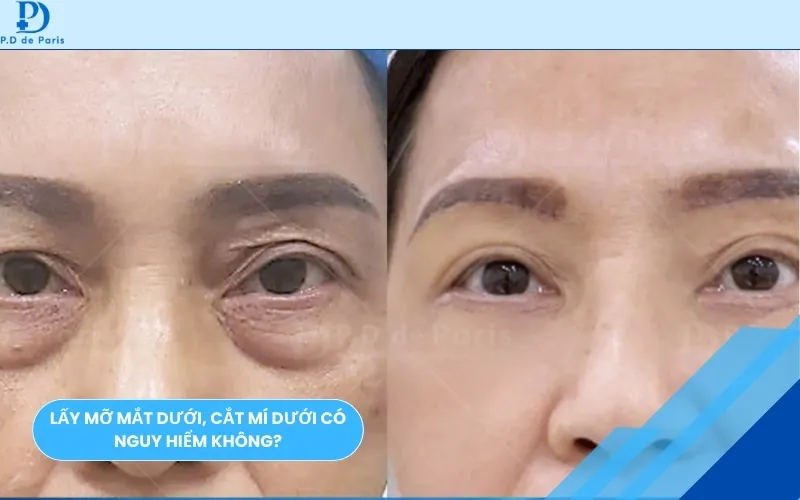 Lấy Mỡ Mắt Dưới, Cắt Mí Dưới Có Nguy Hiểm Không? Tác Hại Thường Gặp