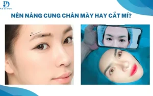 Nâng Cung Mày Hay Cắt Mí Đẹp Hơn? Bảng So Sánh Chi Phí, Hồi Phục, Hiệu Quả