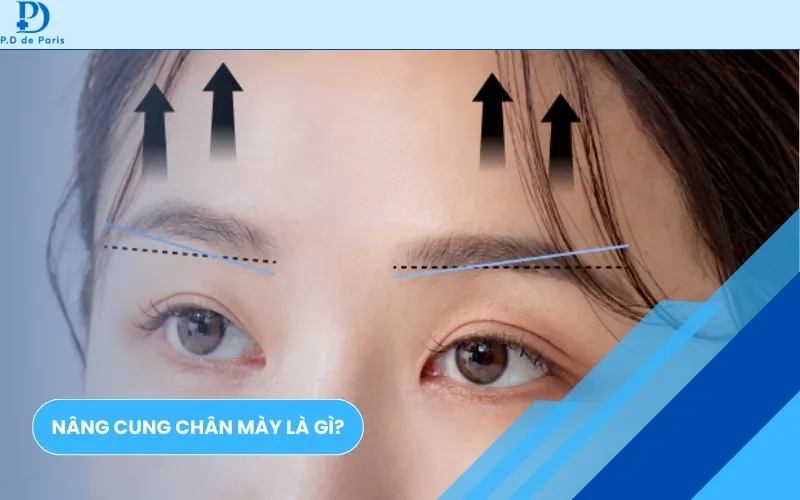 Nâng Cung Mày Hay Cắt Mí Đẹp Hơn? Bảng So Sánh Chi Phí, Hồi Phục, Hiệu Quả