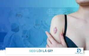 Sẹo lồi là gì? Làm thế nào để điều trị sẹo lồi hiệu quả?