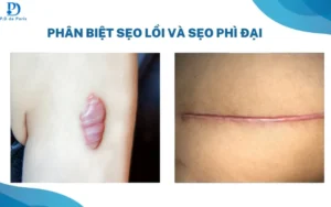 Sẹo lồi và sẹo phì đại khác nhau thế nào? Nguyên nhân và cách nhận biết