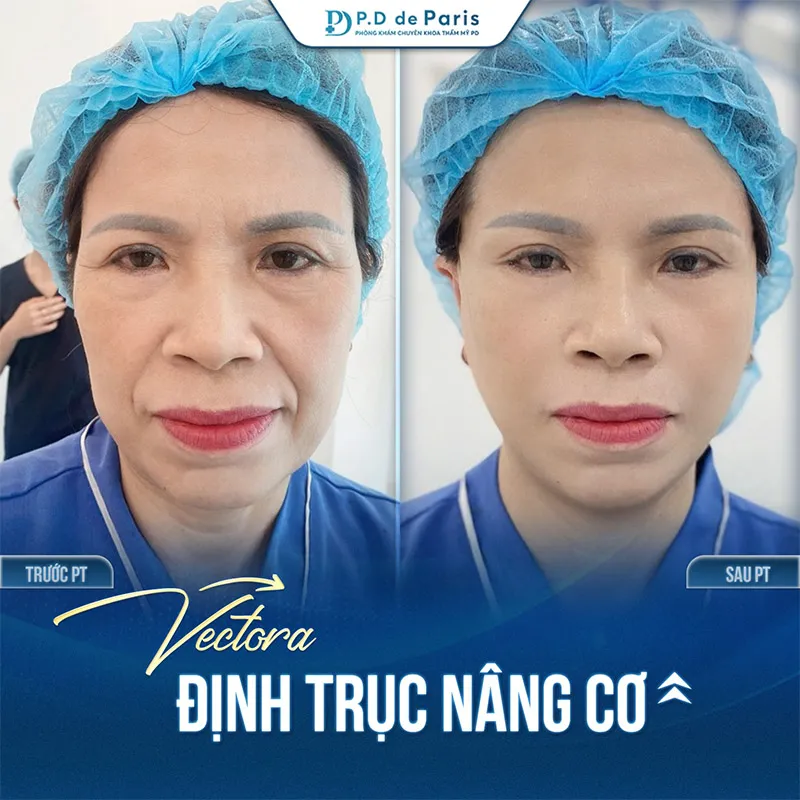 VECTORA – Định Trục Nâng Cơ Phù Hợp Với Độ Tuổi Và Tình Trạng Da Nào?