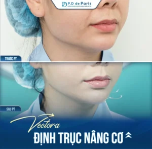 5 Ưu Điểm Vượt Trội Của Phương Pháp VECTORA Định Trục Nâng Cơ So Với Cách Trẻ Hóa Da Mặt Truyền Thống