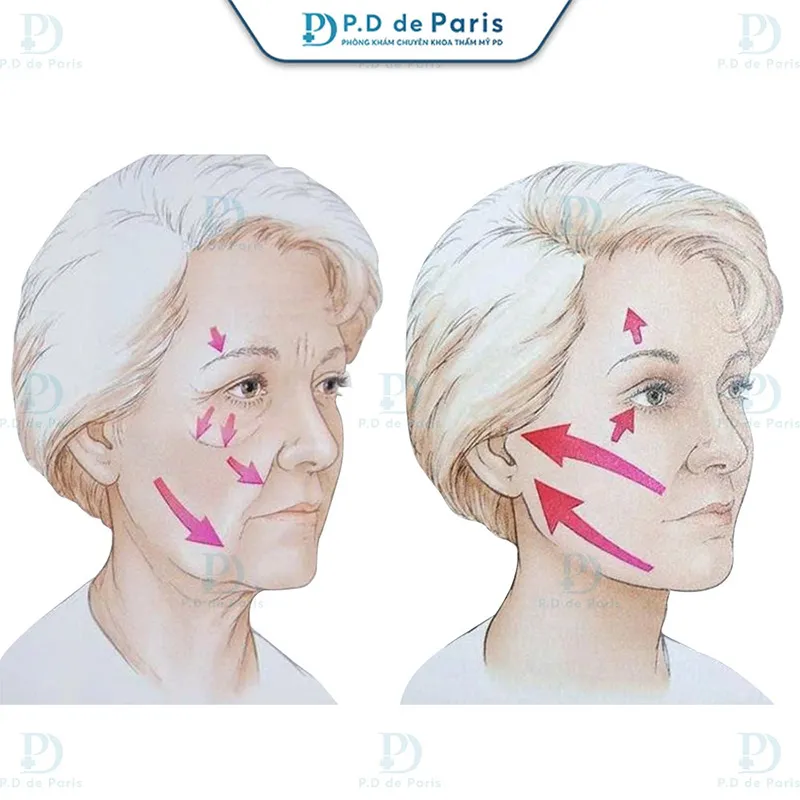 Khám phá quy trình thực hiện VECTORA – Định trục nâng cơ chuẩn y khoa