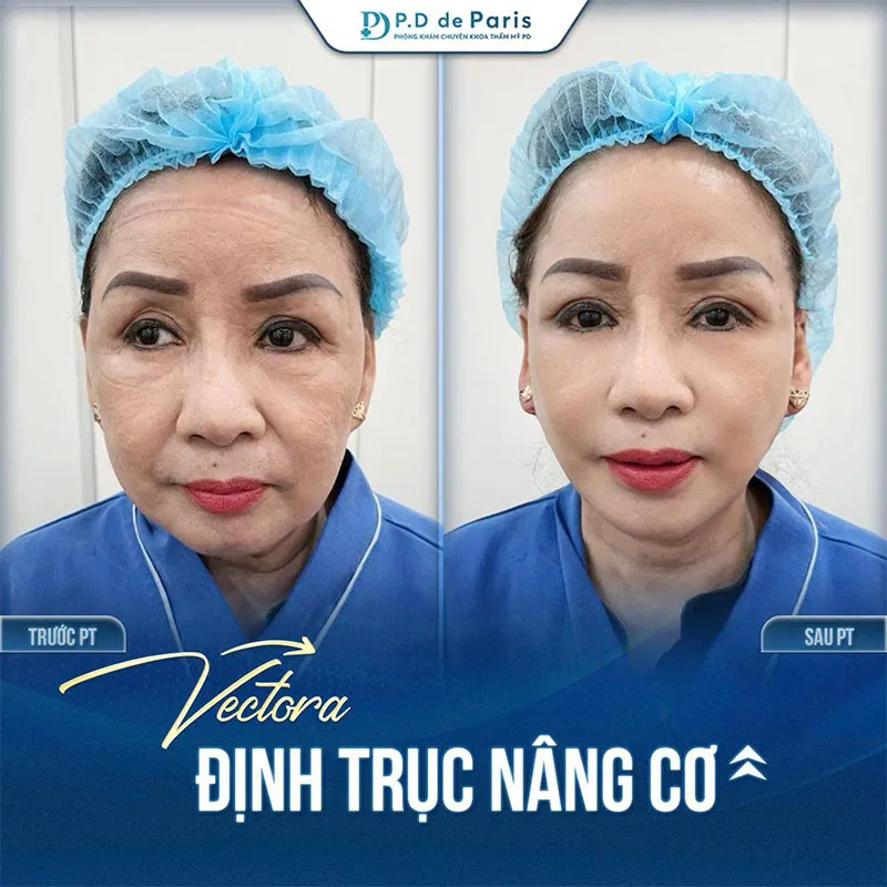 Trẻ Hóa Da Bằng VECTORA Định Trục Nâng Cơ Có Đau Không? Cần Nghỉ Dưỡng Bao Lâu?