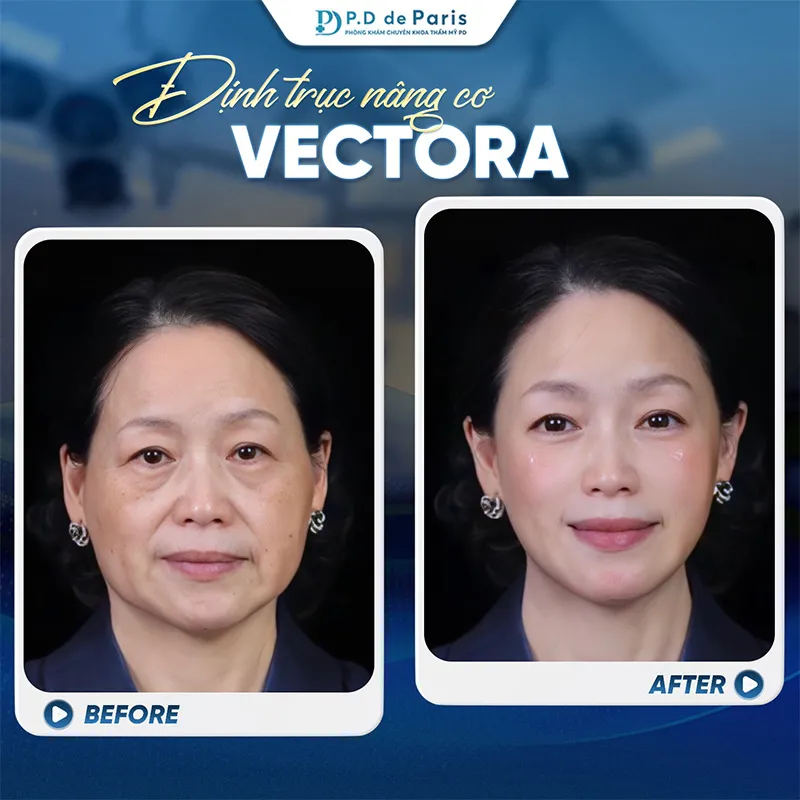 5 Ưu Điểm Vượt Trội Của Phương Pháp VECTORA Định Trục Nâng Cơ So Với Cách Trẻ Hóa Da Mặt Truyền Thống