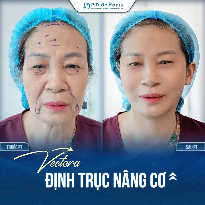 Nên Lựa Chọn VECTORA Định Trục Nâng Cơ Hay Phẫu Thuật Căng Da Để Trẻ Hóa Da Mặt?