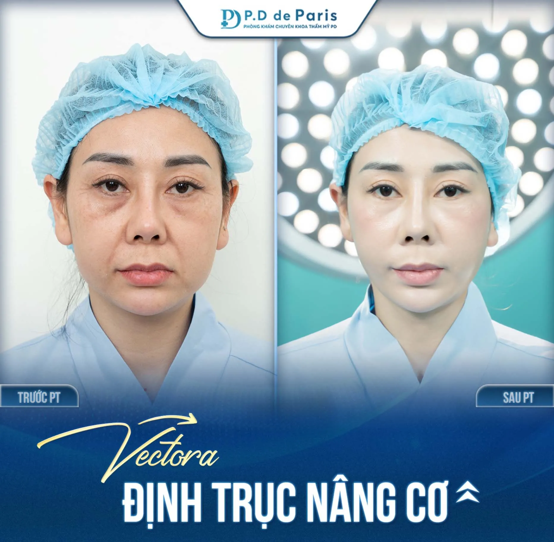 VECTORA – Định Trục Nâng Cơ Phù Hợp Với Độ Tuổi Và Tình Trạng Da Nào?