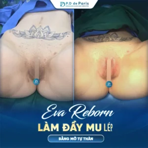 Cấy mỡ môi lớn kiêng ăn gì và nên ăn gì để vết thương mau lành?