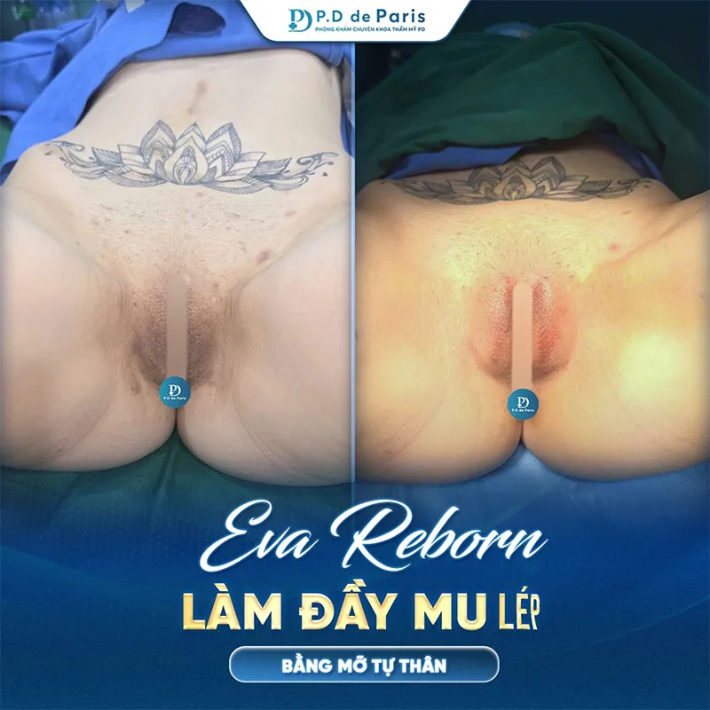 Cấy mỡ môi lớn kiêng ăn gì và nên ăn gì để vết thương mau lành?