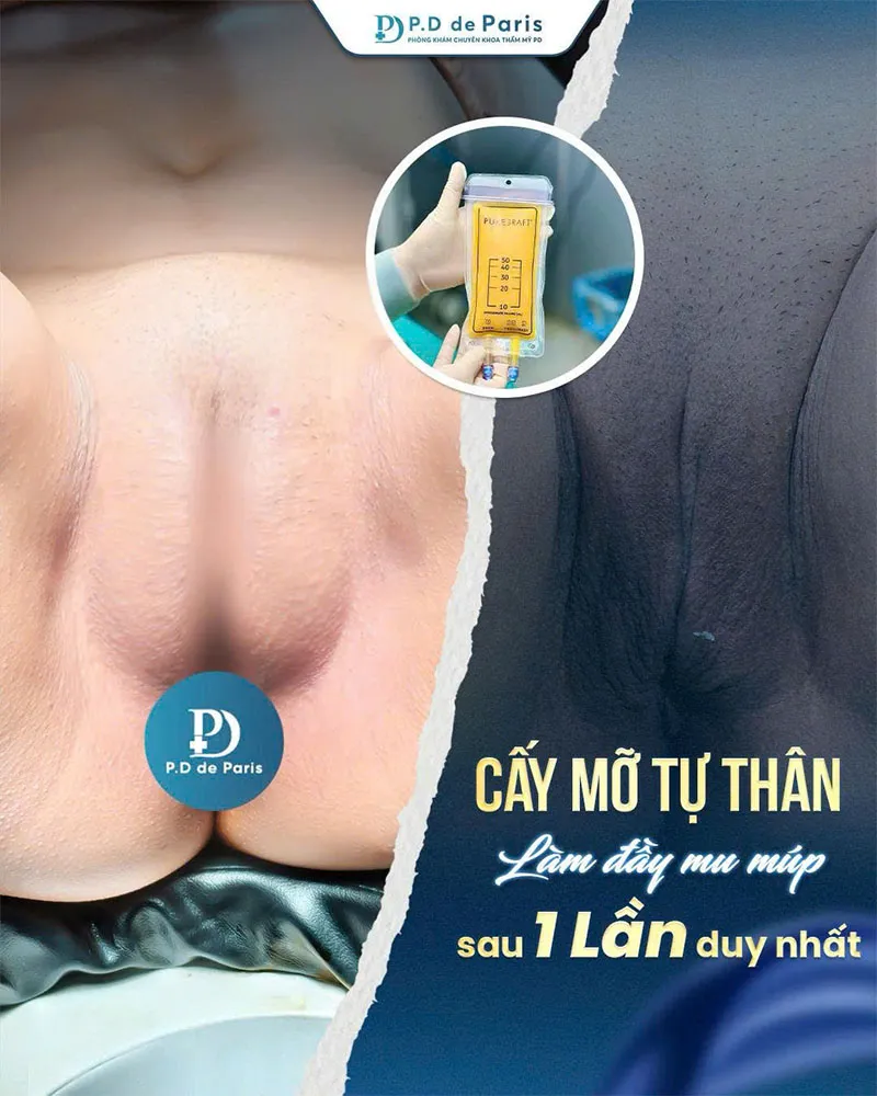 Cấy mỡ môi lớn kiêng ăn gì và nên ăn gì để vết thương mau lành?