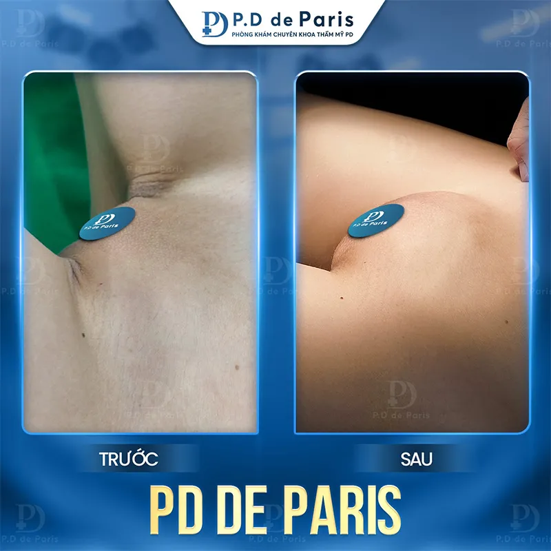 Cấy mỡ môi lớn kiêng ăn gì và nên ăn gì để vết thương mau lành?